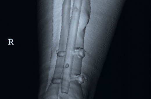 Aquatherapie, Aquatraining bei Margot Zeitvogel-Schönthier, Patient mit Unterschenkelfraktur, Röntgenbild
