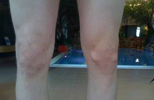 Knie rechts und links von einem Sportler, Zustand nach mehreren Kreuzbandoperationen, Patient bei Margot Zeitvogel-Schönthier zum Aquatraining /-Therapie, Schwimmbecken im Hintergrund.